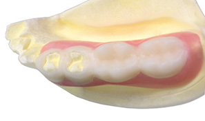 Free end posterior bridge_all WDZ