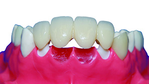 WZ Anterior Bridge_Clean Bkgrd