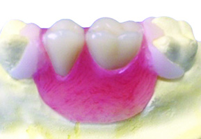 products_pontic_removable_bridge