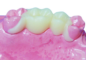 products_removable_bridge